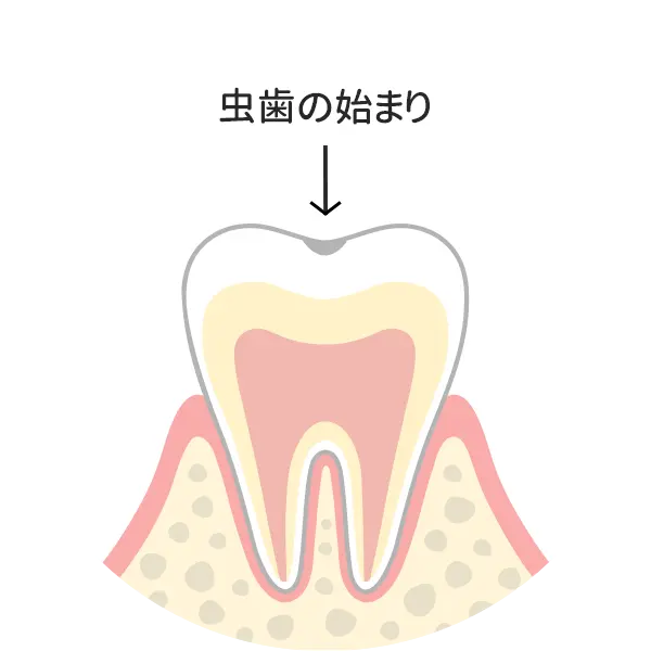 Ｃ０：脱灰
