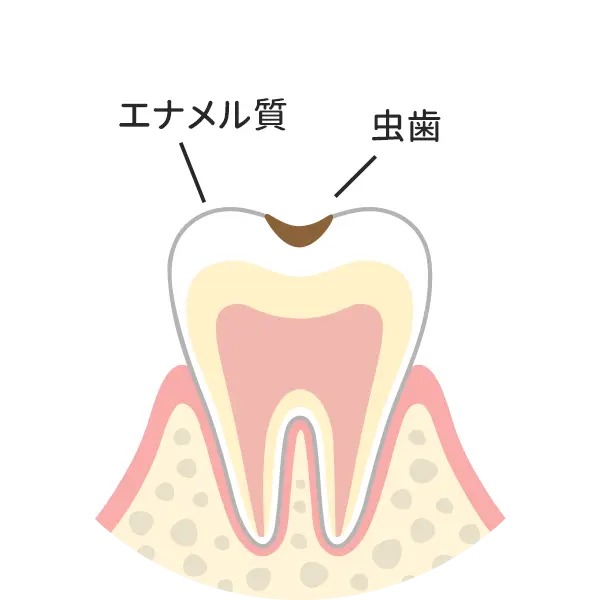 Ｃ１：歯の表層（エナメル質）の虫歯