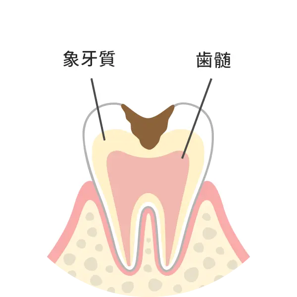 Ｃ２：歯の中（象牙質）まで進んだ虫歯