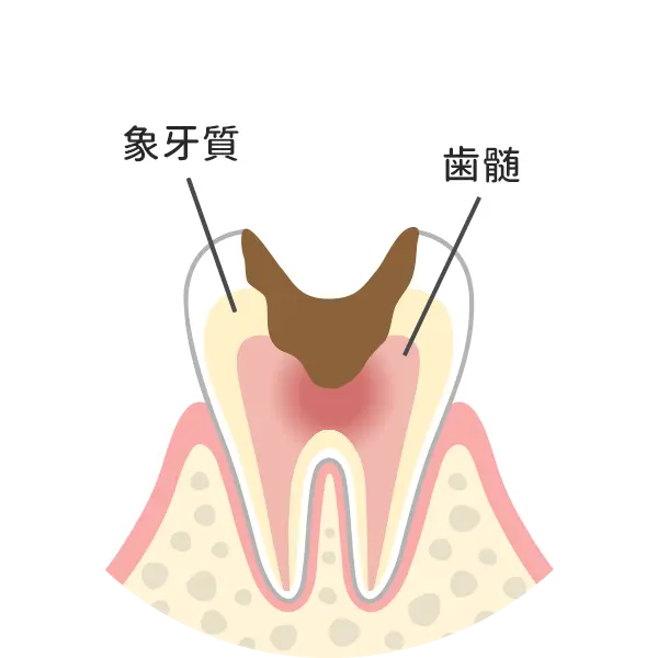 Ｃ３：神経まで達した虫歯