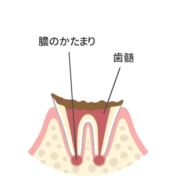 Ｃ４：歯の根まで達した虫歯