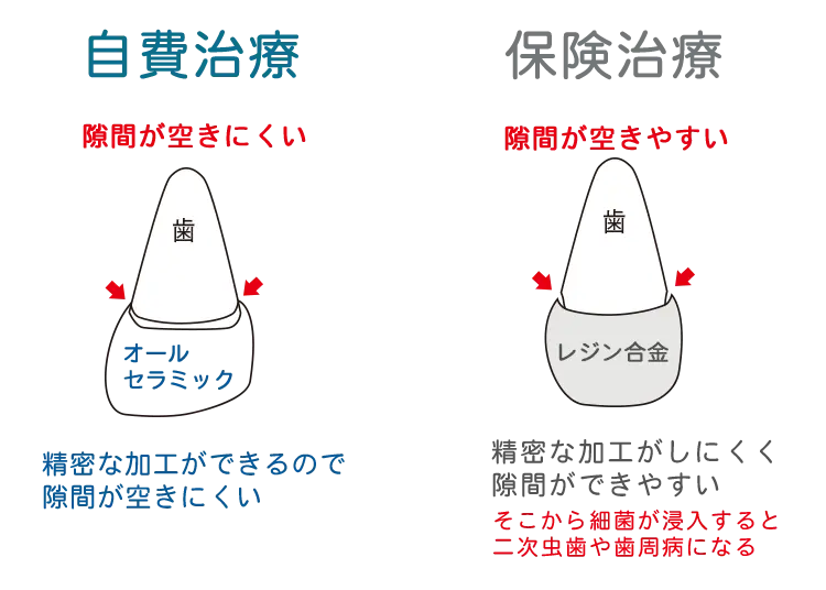 前歯被せ物