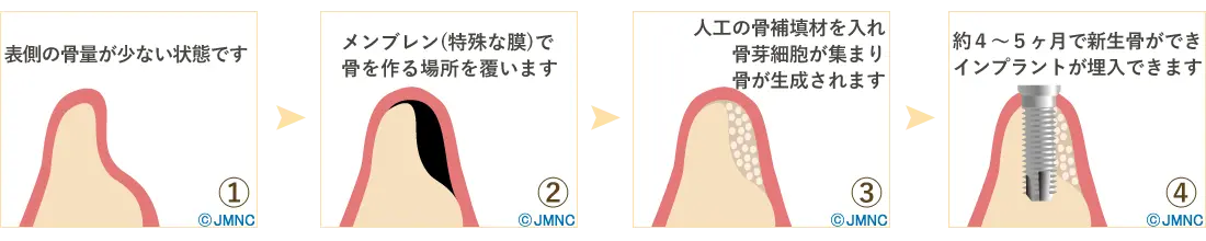 GBR（骨誘導再生法）