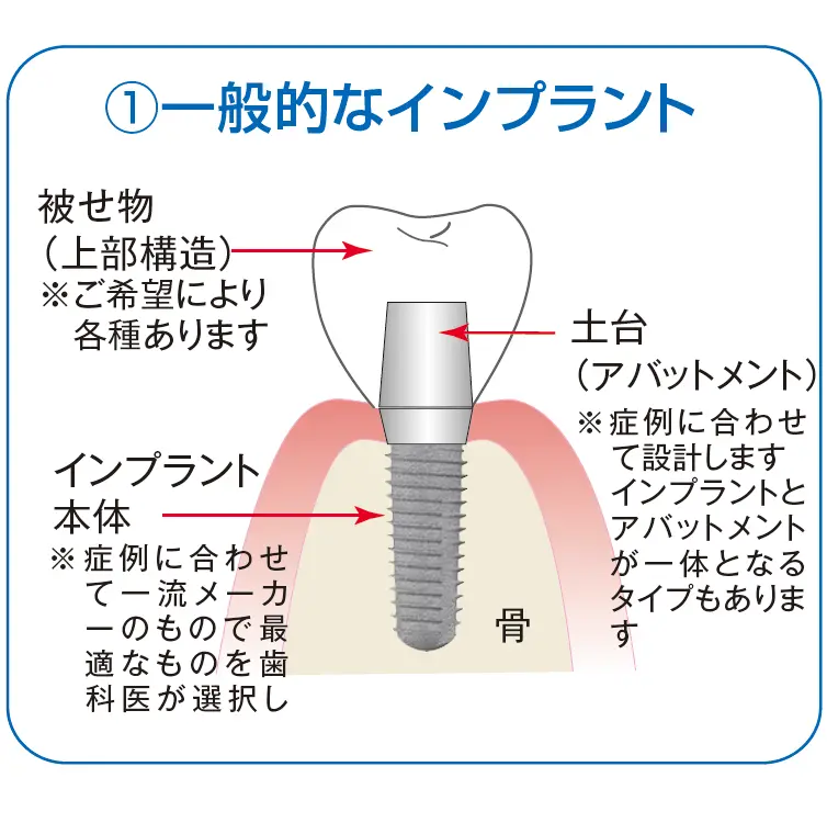 住吉区 インプラント
