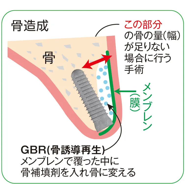 住吉区 骨造成