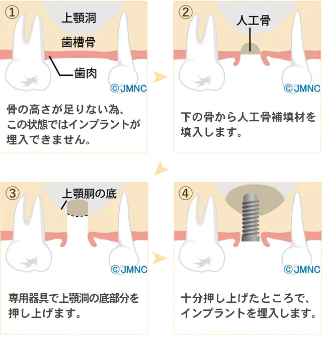 サイナスリフト法