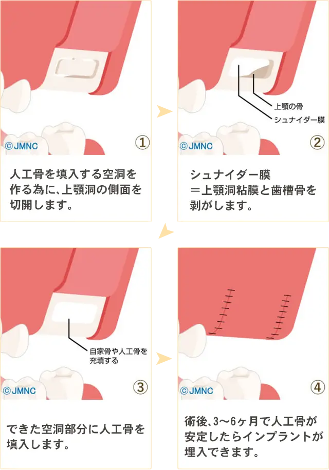 ソケットリフト法