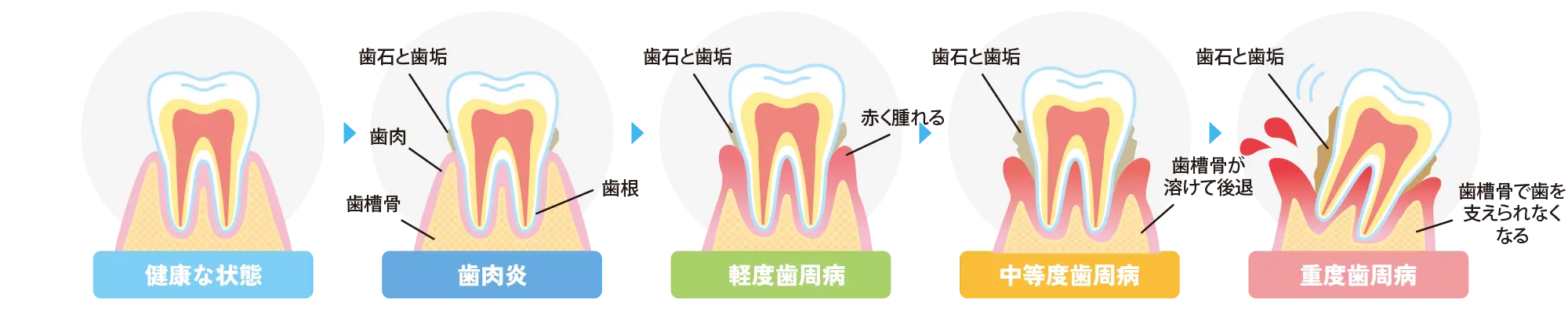 歯周病の進行