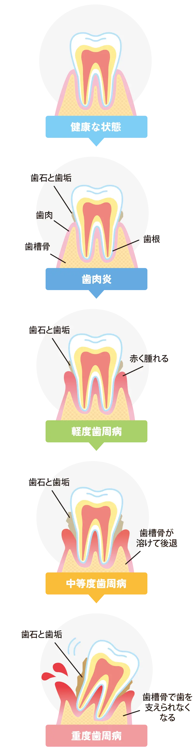 歯周病の進行