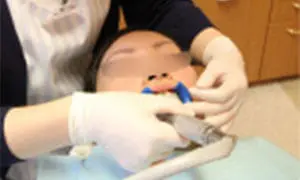 歯の表面の清掃