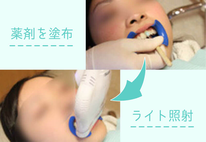 オフィスホワイトニング